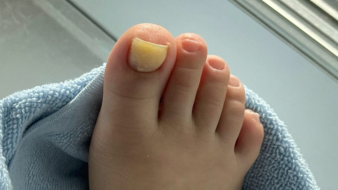 The early signs are easy to miss: a little yellow or thickening at the tip of the toenail.