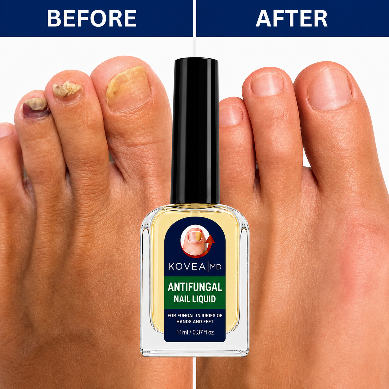 Clear Fungus Nails & Restore Healthy Clear Nails in Just 14 Days!