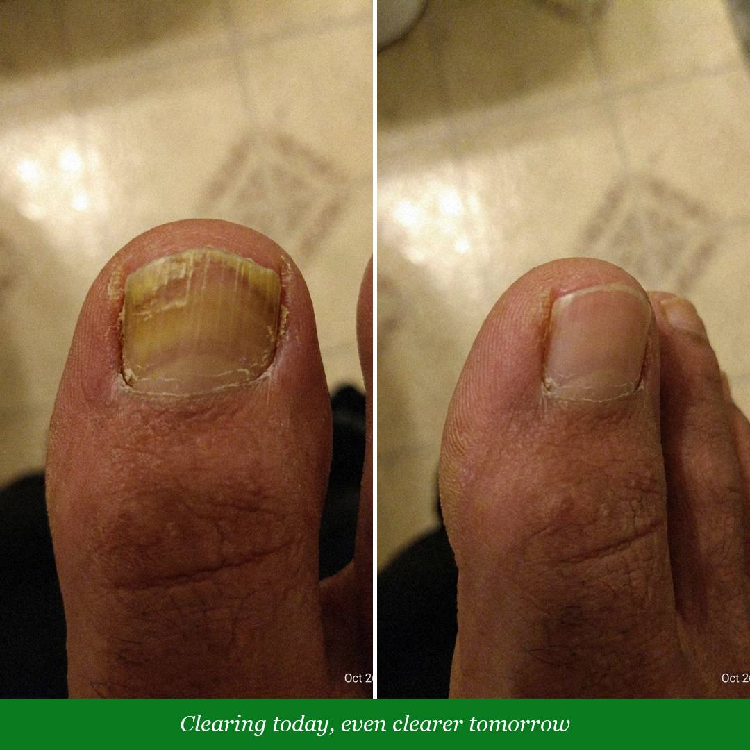Before and after of a fungal toenail clearing