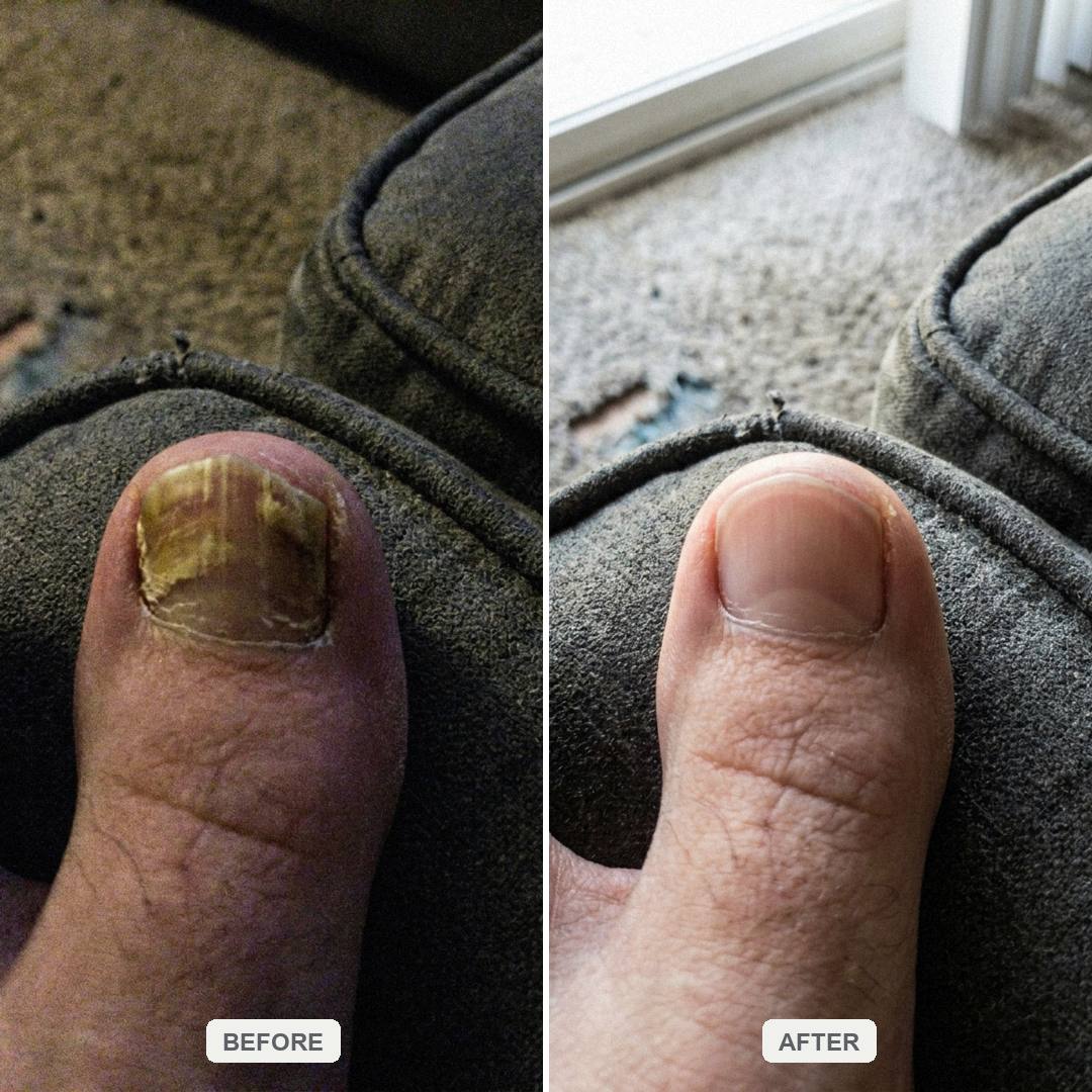 Severe thick fungal nail before and after