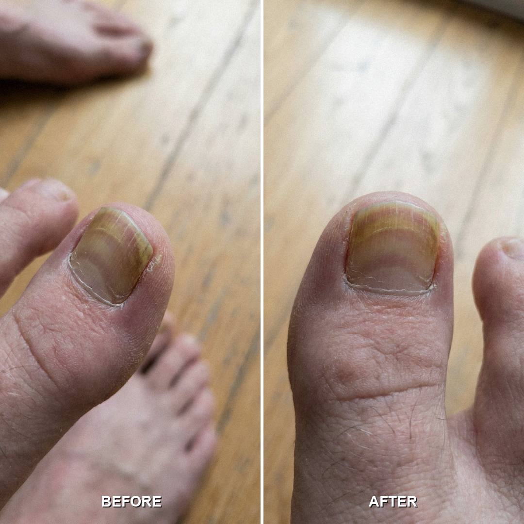 Yellow discoloration fading from the base of the nail